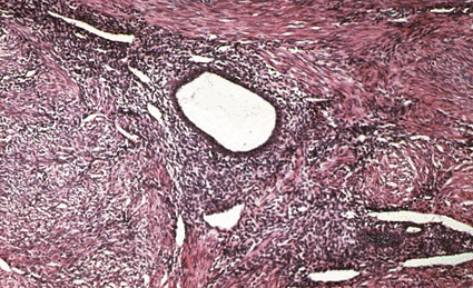 Imagen: Microfotografía de luz mostrando adenomiosis del útero humano (Foto cortesía de Biophoto Associates).